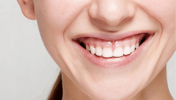 Tìm hiểu về các loại tiểu phẫu nướu hiện nay Tìm hiểu về các loại tiểu phẫu nướu hiện nay