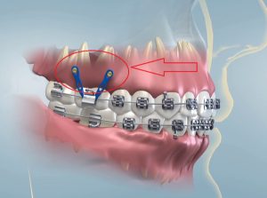 Cắm vít niềng răng là gì? Khi nào cần phải thực hiện?