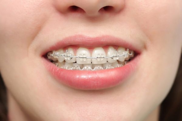 Nha khoa Đồng sẽ giúp bạn giải đáp đâu là giai đoạn xấu nhất khi niềng răng Nha khoa Đồng sẽ giúp bạn giải đáp đâu là giai đoạn xấu nhất khi niềng răng