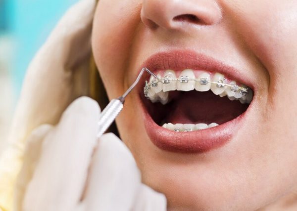 Mỗi giai đoạn niềng răng đều có những điểm riêng biệt Mỗi giai đoạn niềng răng đều có những điểm riêng biệt