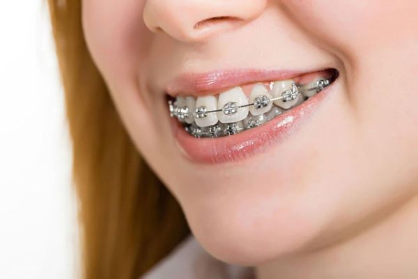Làm sao để có thể vượt qua giai đoạn xấu nhất khi niềng răng Làm sao để có thể vượt qua giai đoạn xấu nhất khi niềng răng