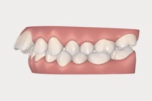 Bị hô hàm có niềng răng được không?
