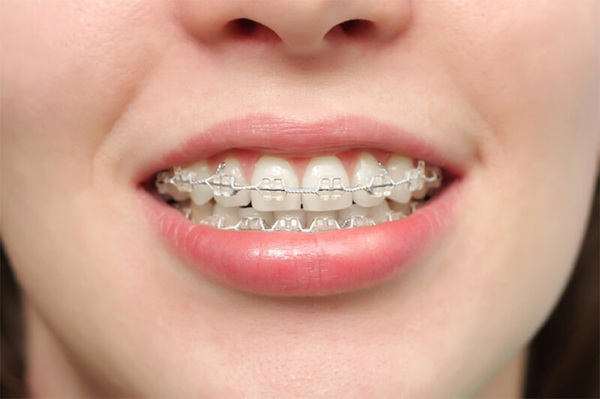 Các phương pháp niềng răng hô hàm phổ biến