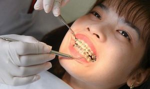 Niềng răng có đau không? Giai đoạn nào đau nhất khi niềng