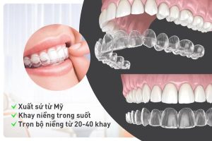 Niềng răng invisalign là phương pháp được nhiều người lựa chọn