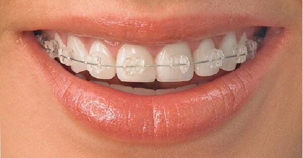 Trả lời câu hỏi niềng răng mắc cài sứ là gì