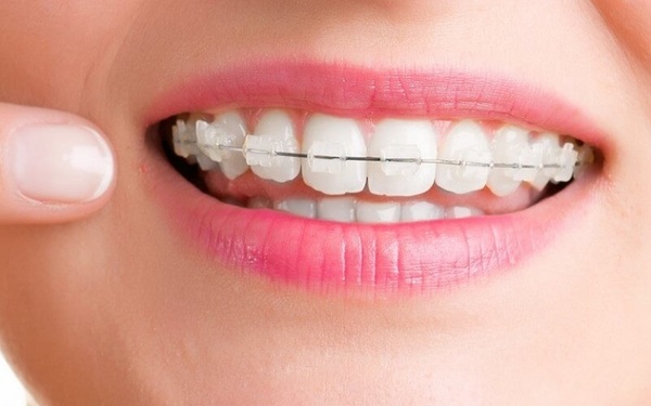 Tìm hiểu ưu và nhược điểm của mắc cài sứ