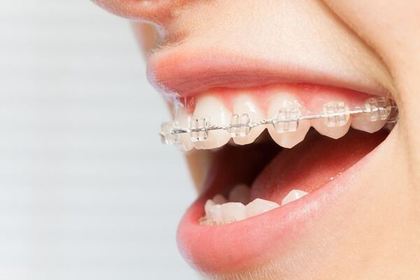Thời gian niềng răng còn phụ thuộc vào tình trạng răng và cách bạn chăm sóc