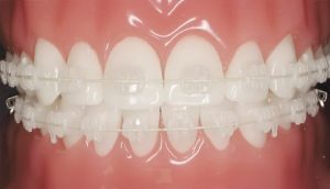 Quy trình niềng răng mắc cài sứ tại nha khoa Đồng