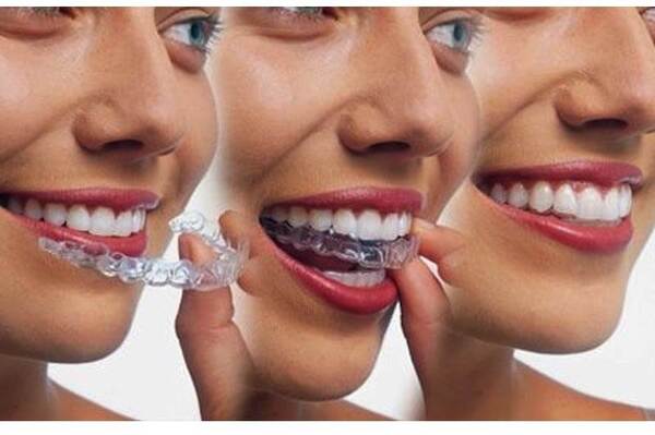 Cách rút ngắn thời gian niềng răng như thế nào? Cách rút ngắn thời gian niềng răng như thế nào?