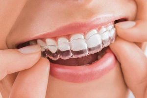 Cùng nha khoa Đồng  tìm hiểu về phương pháp niềng răng trong suốt