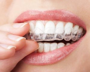 Niềng răng trong suốt có đau không là vấn đề nhiều người quan tâm