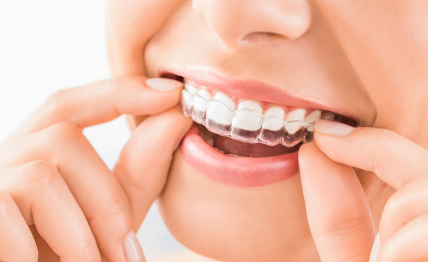 Niềng răng trong suốt có đau không? Niềng răng trong suốt có đau không?