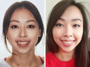 Hình ảnh trước và sau khi niềng răng thay đổi như thế nào?