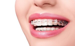 20 tuổi thì vẫn có thể bắt đầu niềng răng