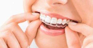 Clear aligner răng