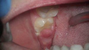 Tình trạng sưng lợi trong cùng