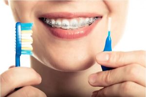 Chăm sóc răng niềng đúng cách đảm bảo quá trình niềng răng hiệu quả