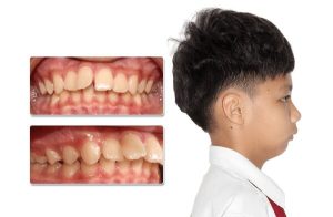 Cằm lẹm là gì?