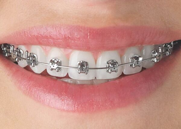 Có khá nhiều thành phần cấu tạo nên dây cung chỉnh nha