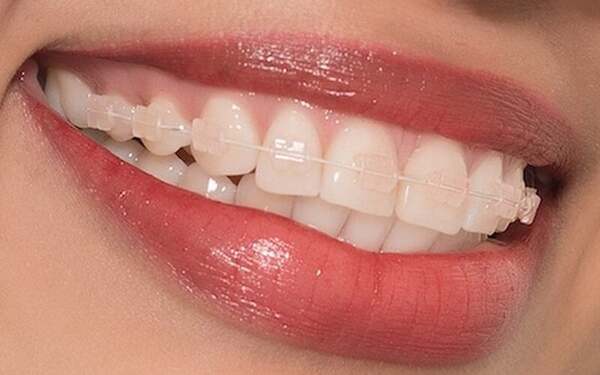 Hiện có 5 phương pháp niềng răng sử dụng dây cung chỉnh nha