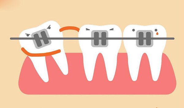 Dây cung sẽ được thay trong khoảng từ 1 - 2 tháng