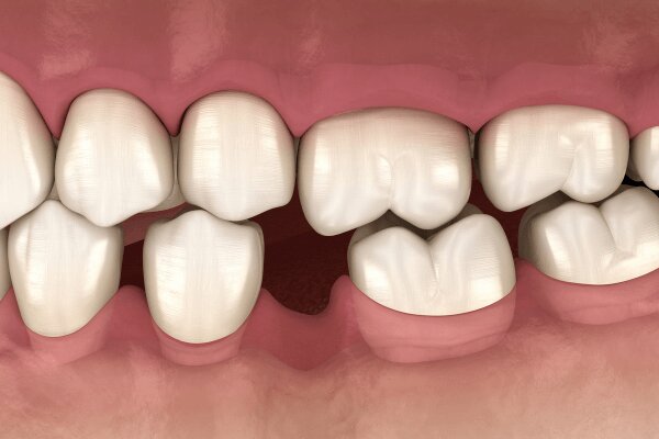 Hóp thái dương khi niềng răng có thật không? Nguyên nhân và cách khắc phực Nguyên nhân làm hóp thái dương trong khi niềng răng