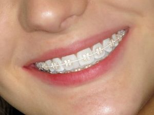 Niềng răng pha lê khác gì so với niềng mắc cài sứ?