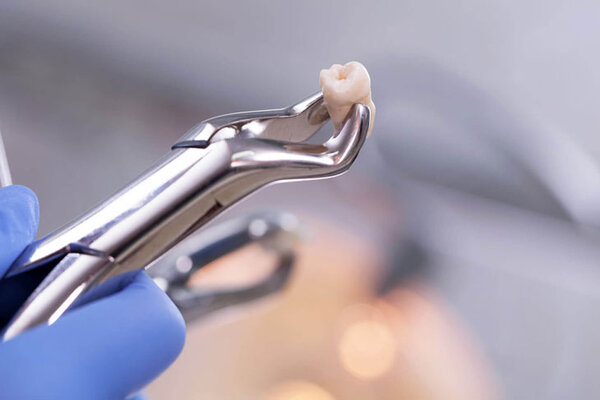 Bác sĩ sẽ thăm khám và chỉ định nhổ răng khôn
