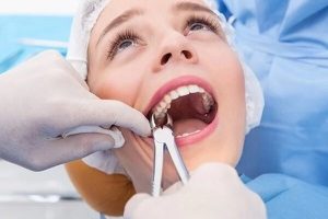 Xem xét loại răng cần nhổ