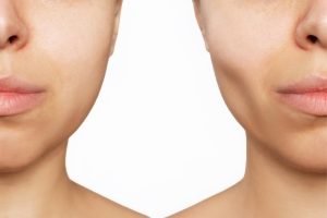 Niềng răng bị hóp má là tình trạng rất phổ biến