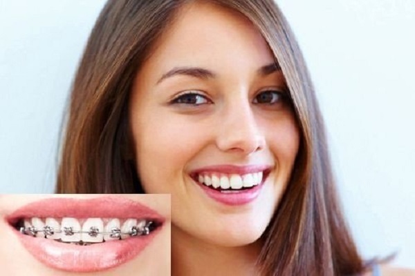 Làm thế nào mới có thể cải thiện vấn đề niềng răng bị hóp má? Làm thế nào mới có thể cải thiện vấn đề niềng răng bị hóp má?