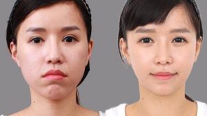 Chuyên gia giải đáp niềng răng có làm thay đổi khuôn mặt không