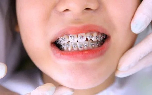 Việc không tái khám đúng lịch hẹn cũng khiến cho niềng răng thất bại