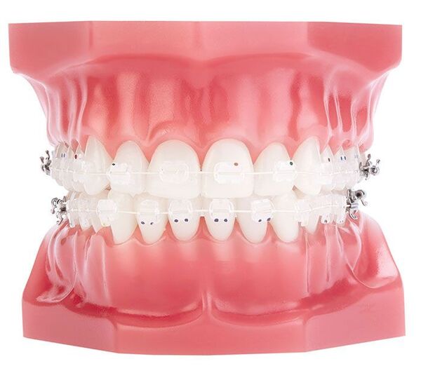 Nhược điểm của chỉnh nha mắc cài sứ