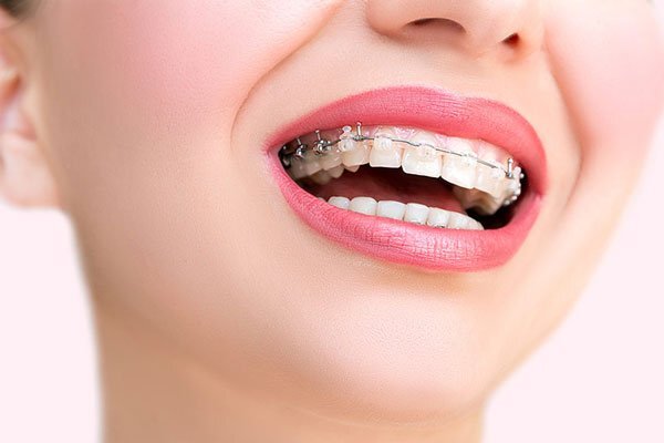 Các yếu tố ảnh hưởng đến thời gian niềng răng