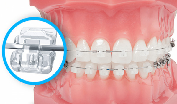 Niềng răng mắc cài sứ giá bao nhiêu tại nha khoa Đồng ?