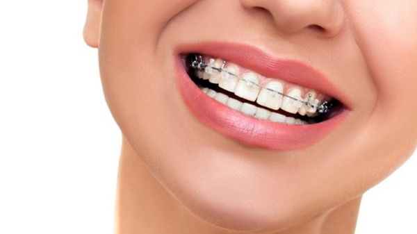 Mới niềng răng nên ăn gì? Mới niềng răng nên ăn gì?