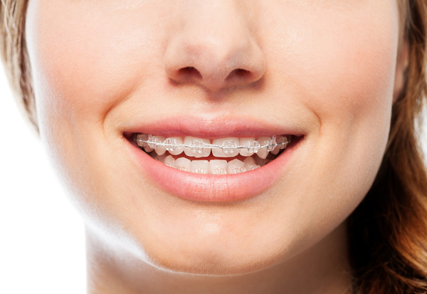 Niềng răng thưa có lâu không? Răng thưa có niềng được không? Niềng răng thưa chỉnh nha là phương pháp được nhiều người biết đến