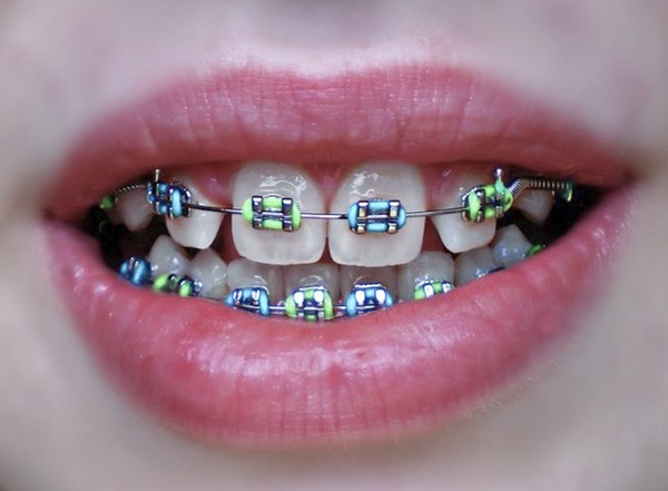 Niềng răng thưa có lâu không? Răng thưa có niềng được không? Cần chọn nha khoa uy tín để niềng răng thưa