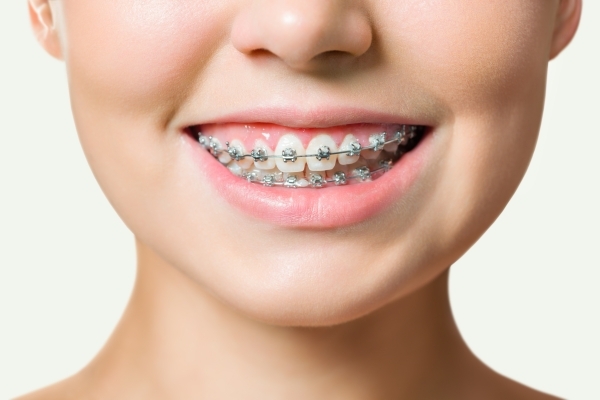 Niềng răng xong có thay đổi khuôn mặt và đẹp hơn không? Hay niềng răng xong vẫn xấu?