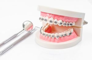 Các bước trong niềng răng chính xác tại nha khoa là gì?