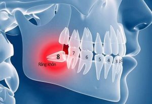 Răng khôn là răng số mấy và cách phát hiện khi chúng mọc?