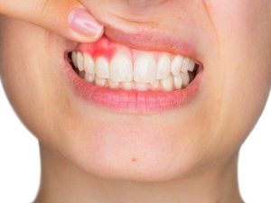Tình trạng viêm lợi