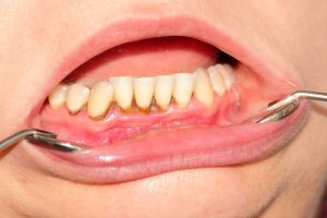 Vôi răng là gì? Tác hại của việc để vôi răng lâu năm không cạo