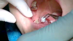 10 dấu hiệu mọc răng khôn phổ biến nhất hiện nay