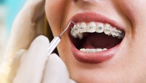 Niềng răng bị tụt lợi: Nguyên nhân và cách khắc phục tốt nhất