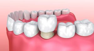 Tìm hiểu về bọc răng sứ là gì?