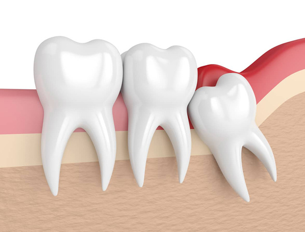 Răng khôn là loại răng số 8 mọc ở con người khi đạt đến độ tuổi trưởng thành Răng khôn là loại răng số 8 mọc ở con người khi đạt đến độ tuổi trưởng thành