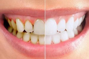 Lấy cao răng có tốt cho răng miệng không? Những lưu ý cần biết